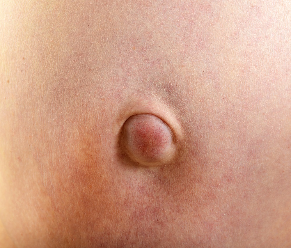 Umbilical Hernia In An Adult 51
