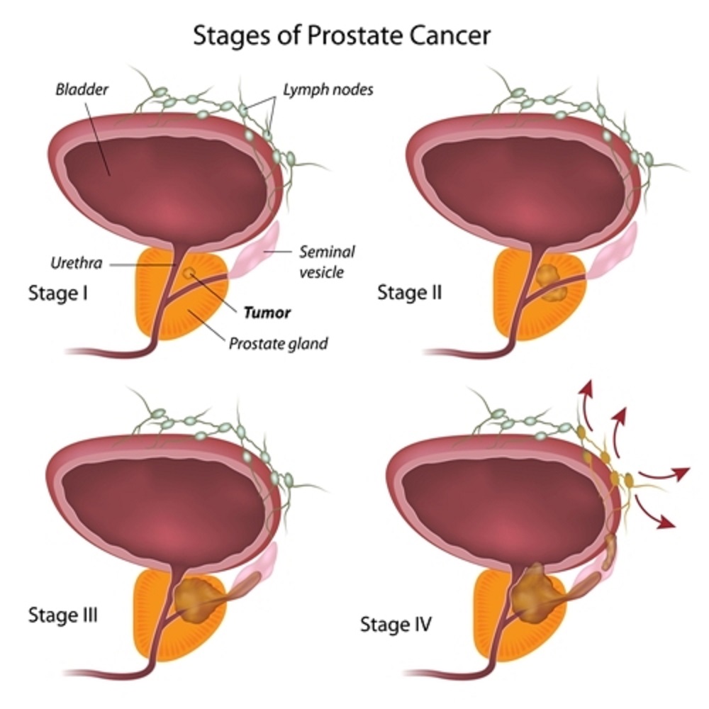Bei der Behandlung von Prostatakrebs kann der HIFU als Primärtherapie sowie bei Rezidiven angewendet werden. 