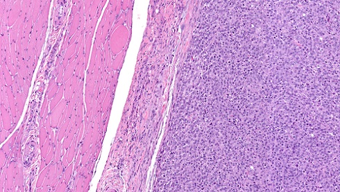 Под микроскопом: разница в строении нормальной (слева) и опухолевой (справа) мышечной ткани