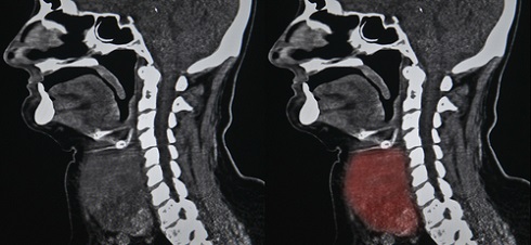 Опухоль щитовидной железы при КТ в боковой проекции