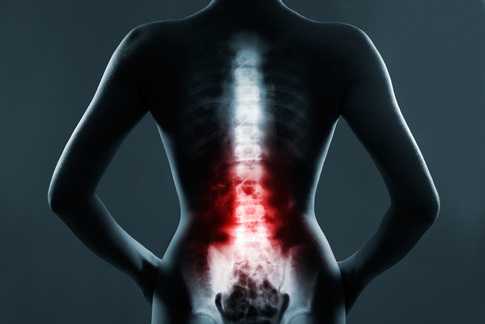 Diagnosis: vertebral body fracture