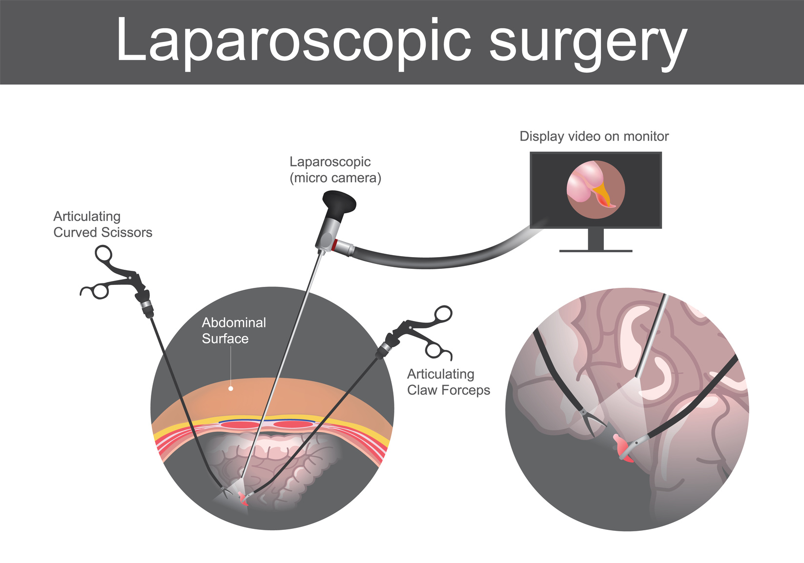 Лапароскопическая хирургия