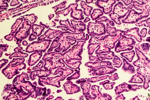 Клетки рака щитовидной железы при микроскопии