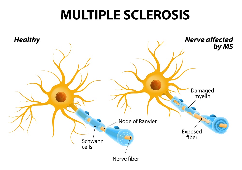 In patients with MS, the nerves of the brain and spinal cord are damaged by their own immune system, resulting in loss of muscle control, vision and balance. 