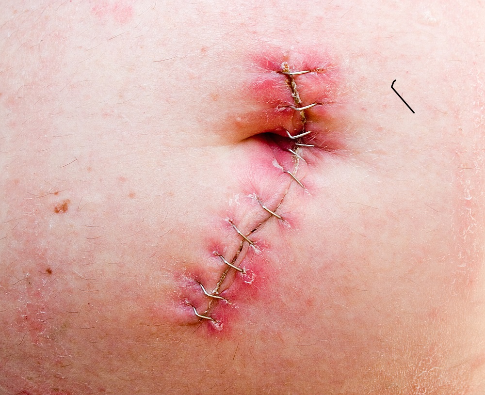A navel after an umbilical hernia operation