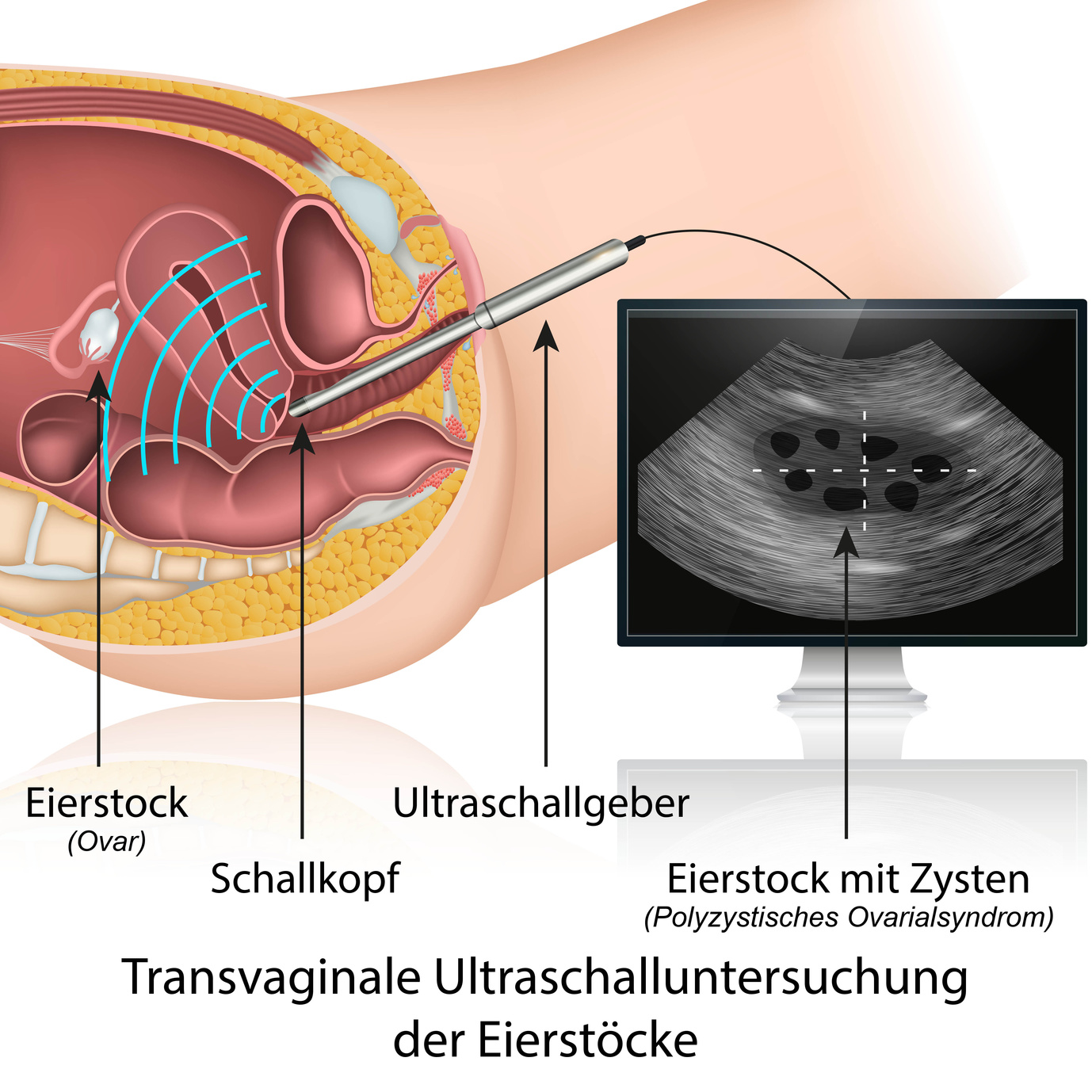 Трансвагинальное УЗ-обследование яичников