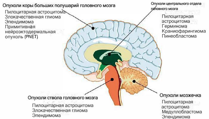 Локализации различных опухолей головного мозга