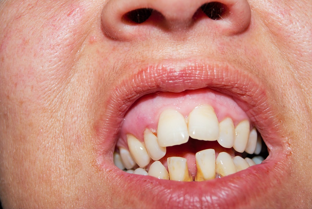 Patient with dental damages