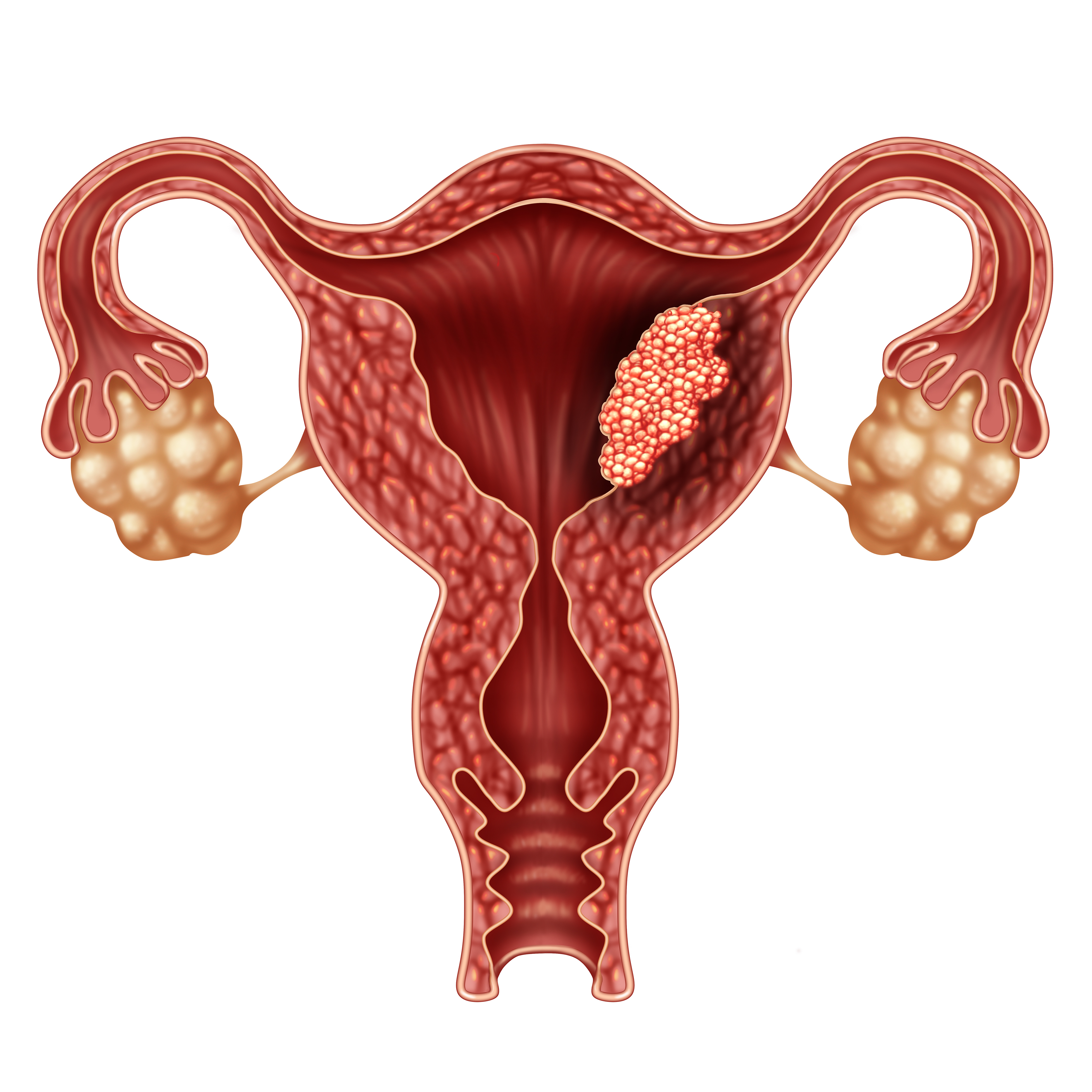 Рак тела матки, развивающийся из клеток ее слизистой оболочки — эндометрия