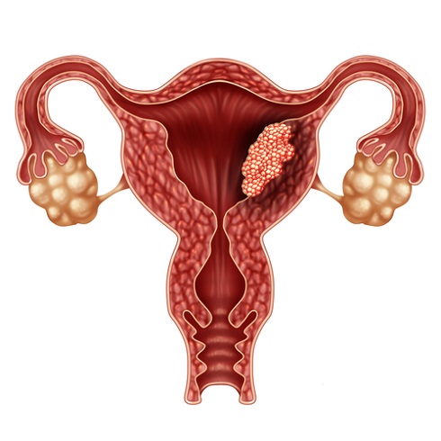 Рак тела матки развивается из клеток её слизистой оболочки