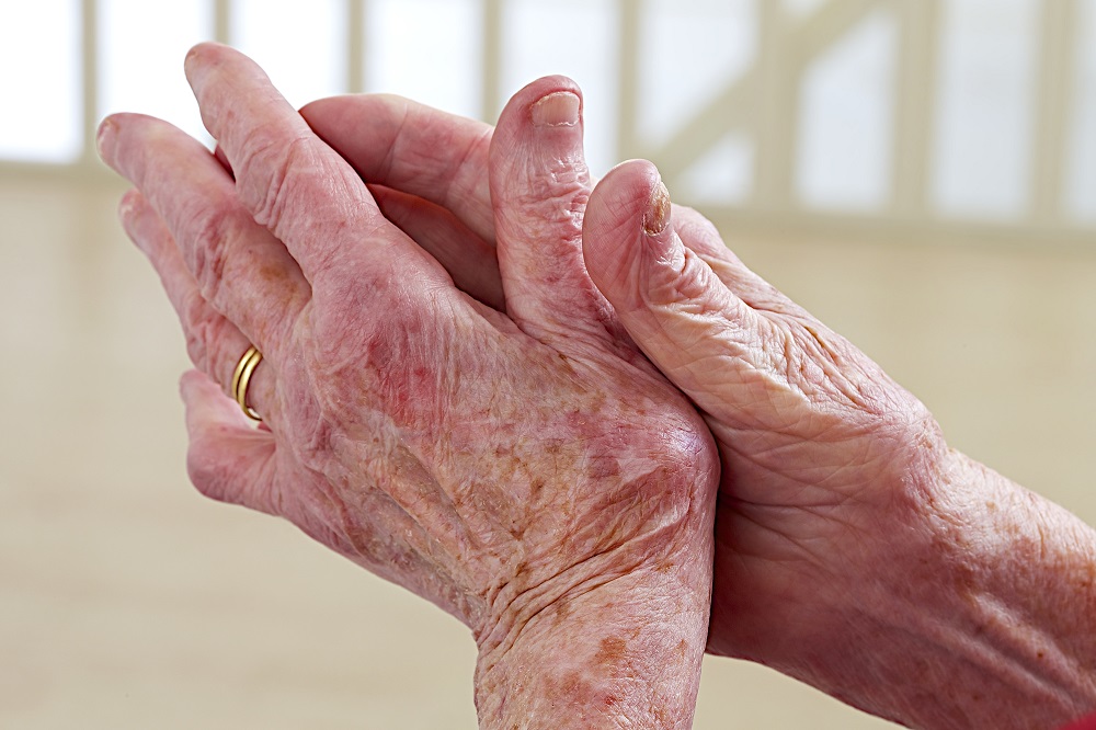 Arthrosis of thumb and finger joints is more common in elderly people