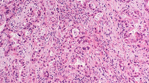 Микроскопия материала биопсии — выявлены признаки рака поджелуждочной железы