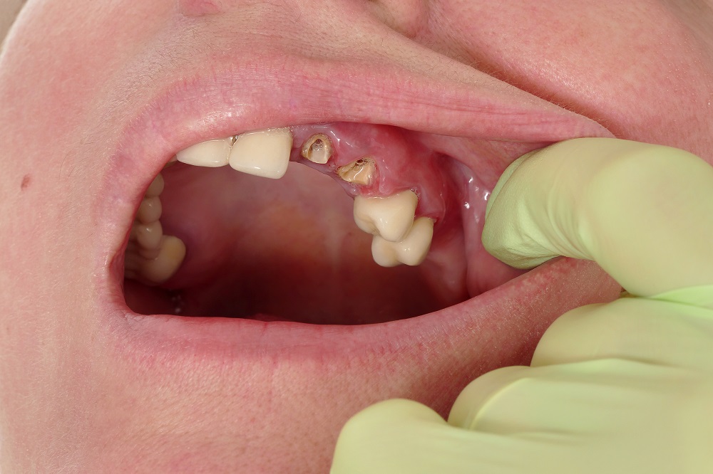 Broken artificial tooth, inflammation, gingivitis