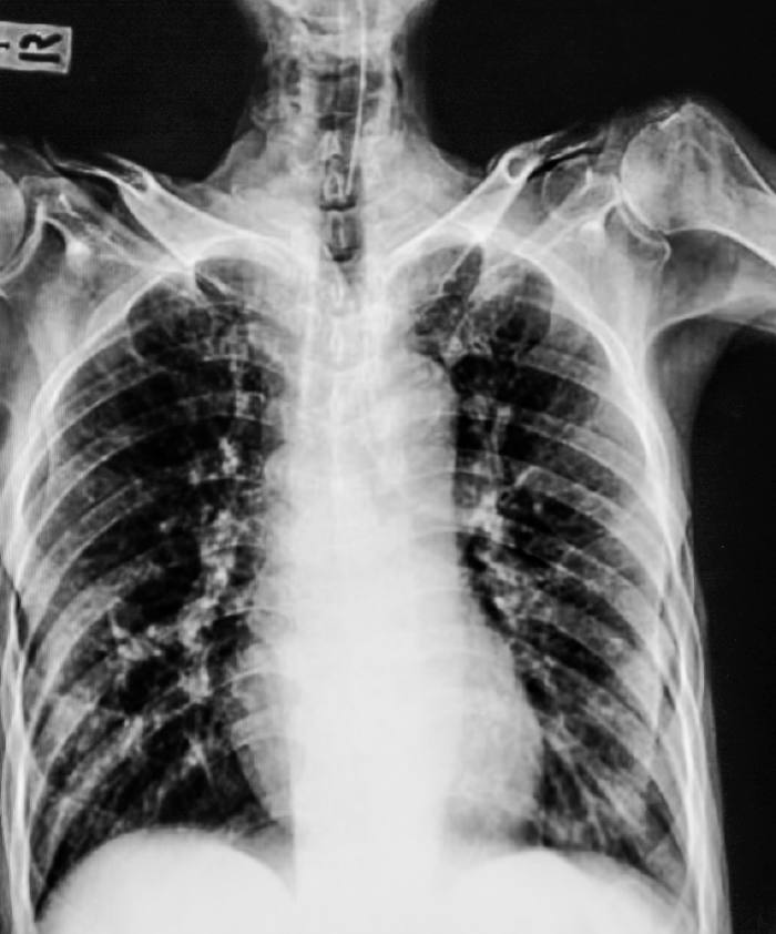 Рентген легких пациента с пневмофиброзом