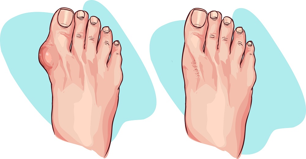 Foot with hallux and healthy foot 