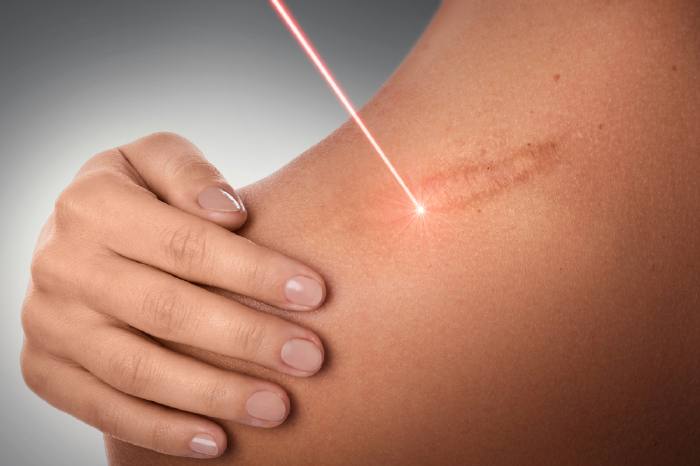 Удаление шрама с помощью лазера